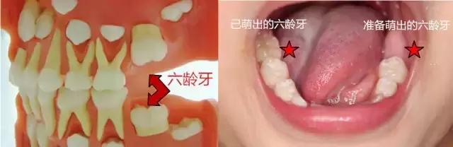 孩子换牙后牙齿越来越难看,小孩换牙为什么牙齿凹凸不平图片
