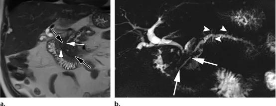急性胰腺炎和慢性胰腺有什么症状,胰腺炎合并胰腺肿物