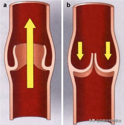 你了解静脉曲张吗,下肢静脉曲张常识