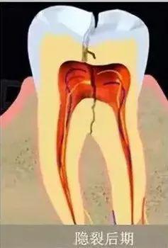 根管治疗不做牙冠就补牙行吗,不做根管治疗的牙戴牙冠好吗