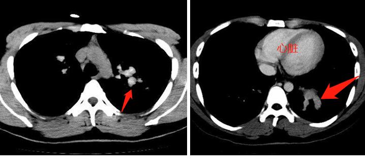 霉菌菌丝不小心吸入,霉菌无处不在
