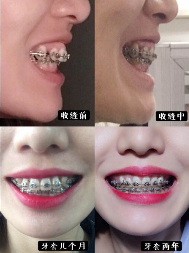 杭州做矫正牙齿价格多少,在杭州做牙齿修复多少钱