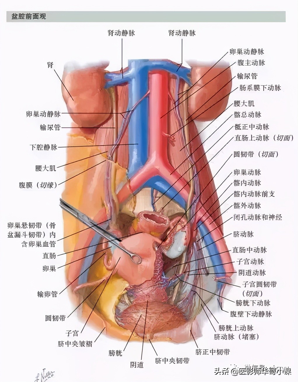盆腔积液ct解剖图谱,盆腔解剖图谱手绘步骤