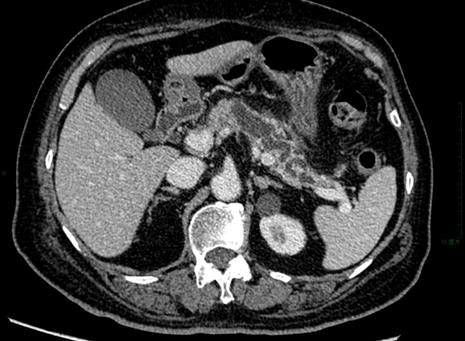 胰腺有哪些罕见病,胰腺上面最容易长的啥东西
