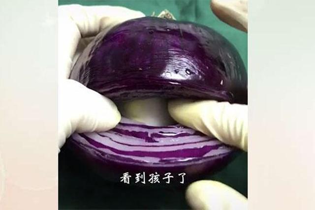 切洋葱剖腹产,洋葱剖腹产手术