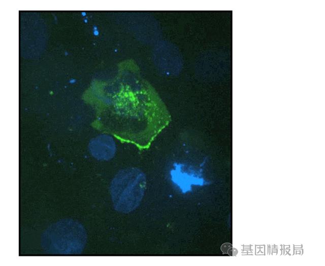 艾滋病病毒入侵全过程曝光,世界上被证实的艾滋病毒体外感染