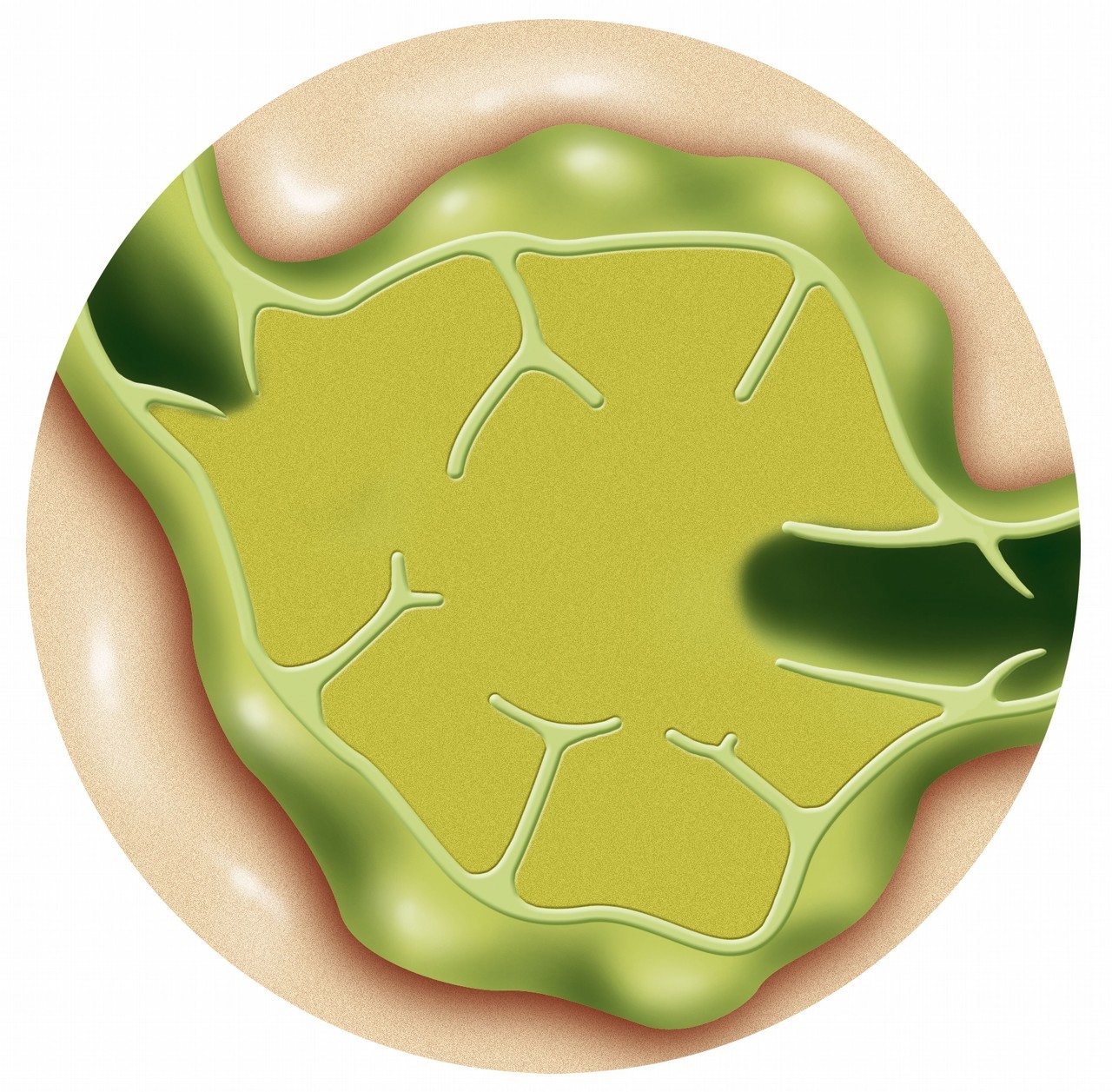 甲癌全切后复查出淋巴结行吗,甲状腺淋巴结转移性癌可以不手术
