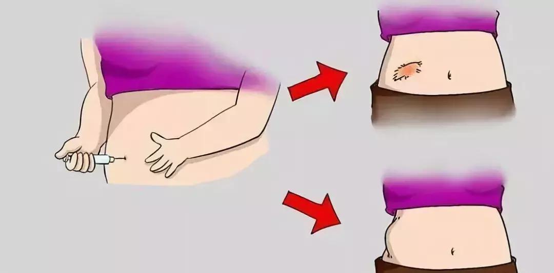 胰岛素注射部位红肿硬化怎么办,打胰岛素肚皮有硬结淤青怎么回事