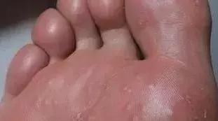 夏天不想穿凉鞋又怕得脚气怎么办,脚气夏天穿不了凉鞋怎么办