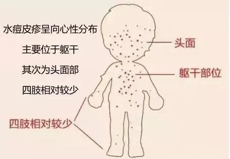 在水痘高发期少喝水是正确的吗,水痘进入高发期专家提醒接种疫苗