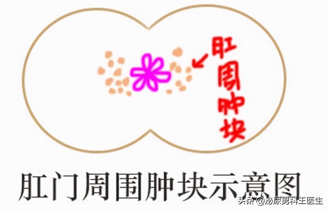 难以启齿的病是什么病,难以启齿的病状