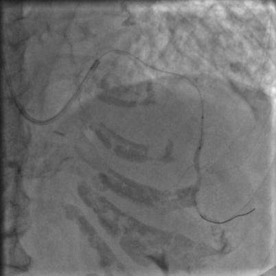 85岁老人心脏堵塞,77岁老人冠脉狭窄放支架还是搭桥
