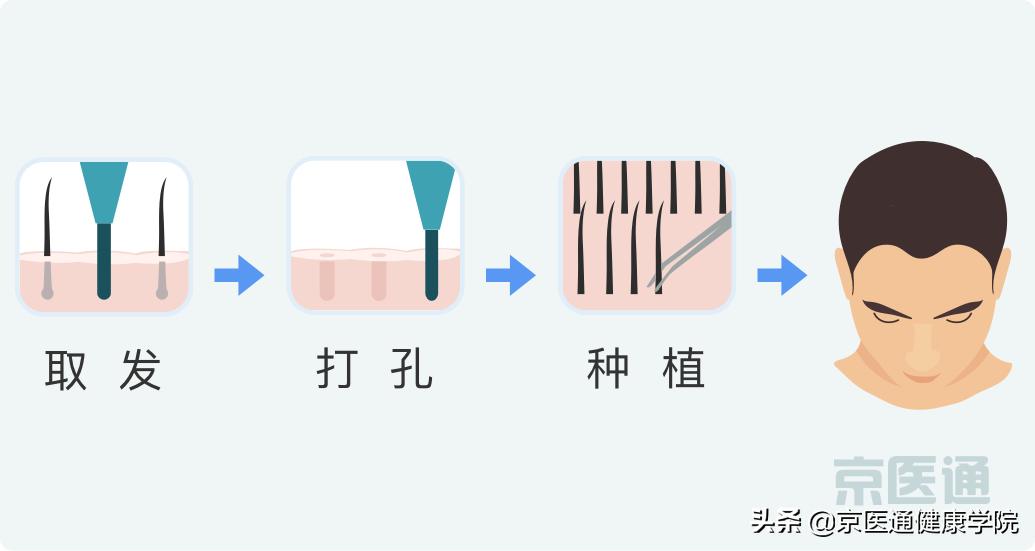 脱发掉发人福音来了,脱发人数2亿