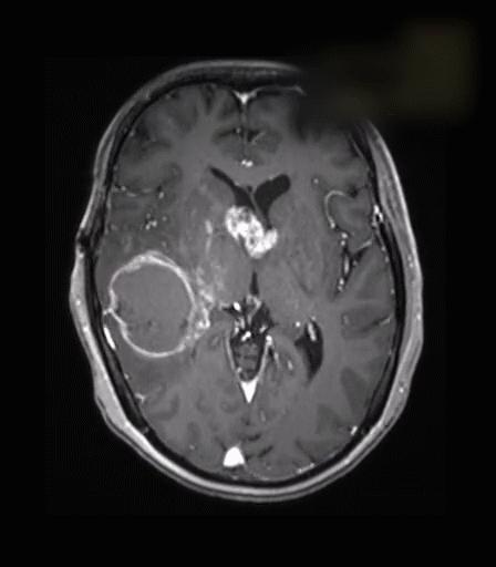 良性脑瘤一般能活多久,良性脑瘤没切干净要化疗