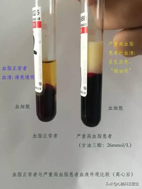 甘油三酯多高需警惕胰腺炎,甘油三酯降到正常值胰腺会好吗