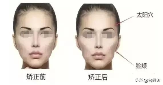 矫正时牙套脸可以去填充吗,戴牙套可以改善脸不对称吗