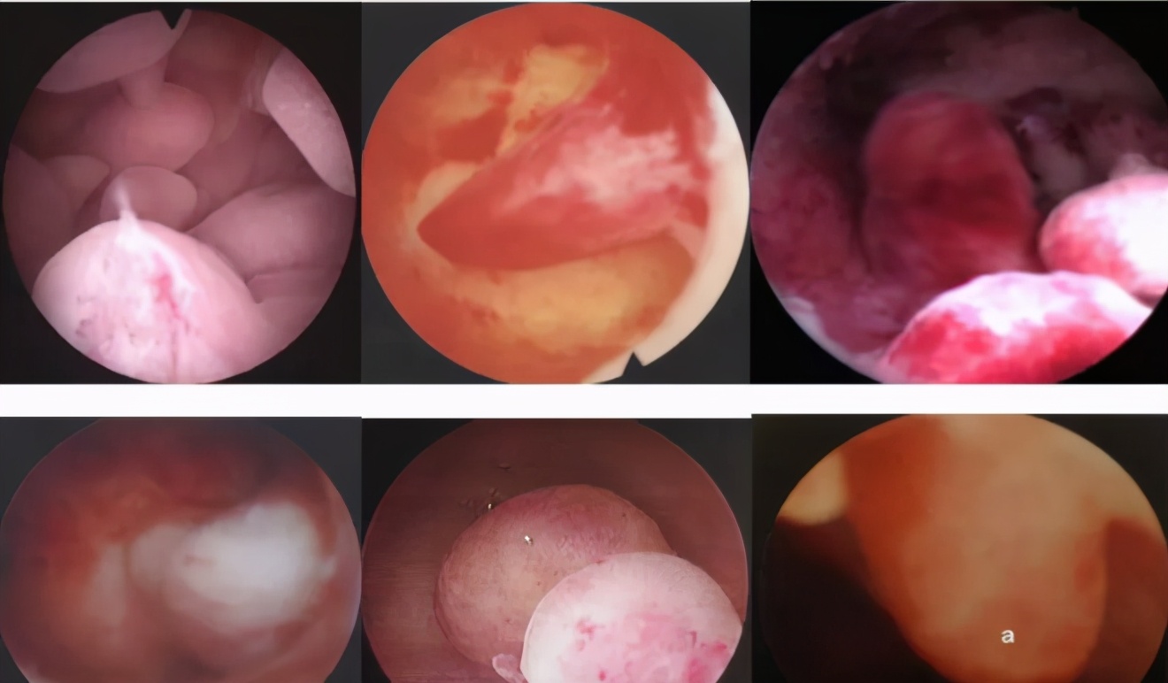 肌瘤和子宫内膜息肉都可以怀孕吗,多发性子宫内膜息肉可以怀孕吗
