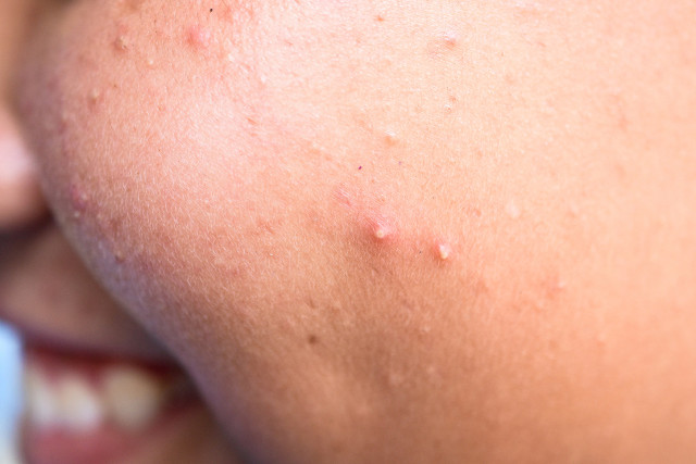 脓包有白色脓点能挤吗,痘痘挤出来的白色乳浆要挤吗