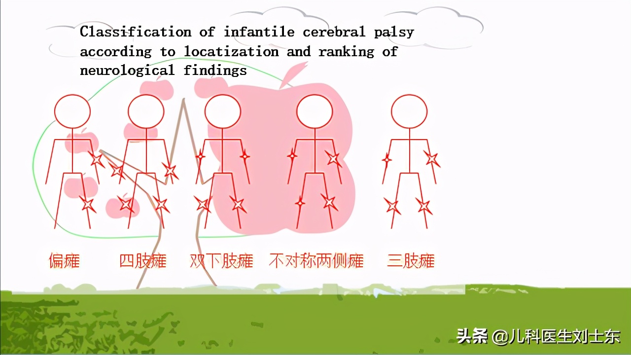 肉毒素治疗脑瘫患儿成功案例,肉毒素治疗脑瘫肌肉痉挛的效果