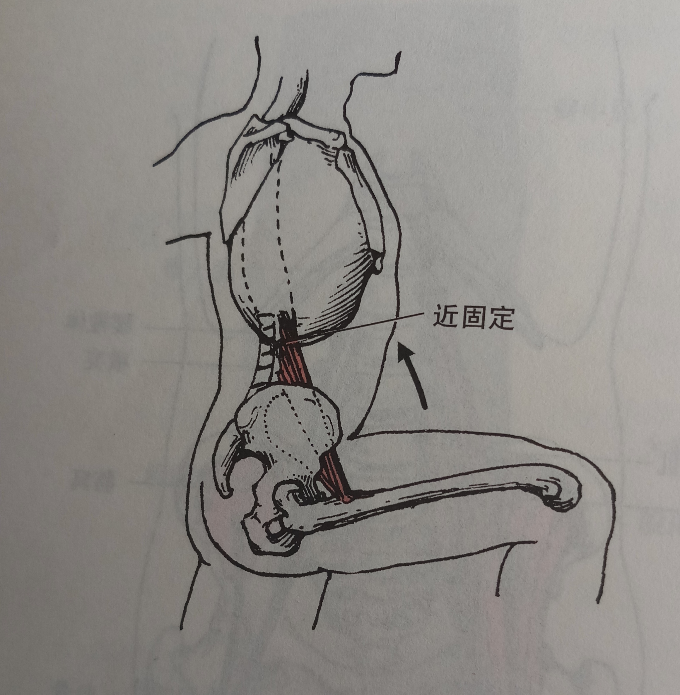 锻炼髂腰肌引起的腰疼怎么治,髂腰肌紧张导致的腰酸怎么办