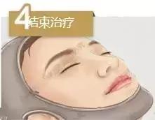 线雕一般多久做一次比较好,线雕多做几次维持的时间会越长吗