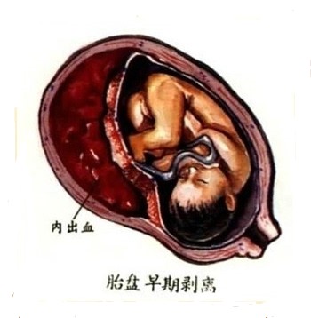 孕期出血就会流产吗,孕期出血是流产多了导致的吗