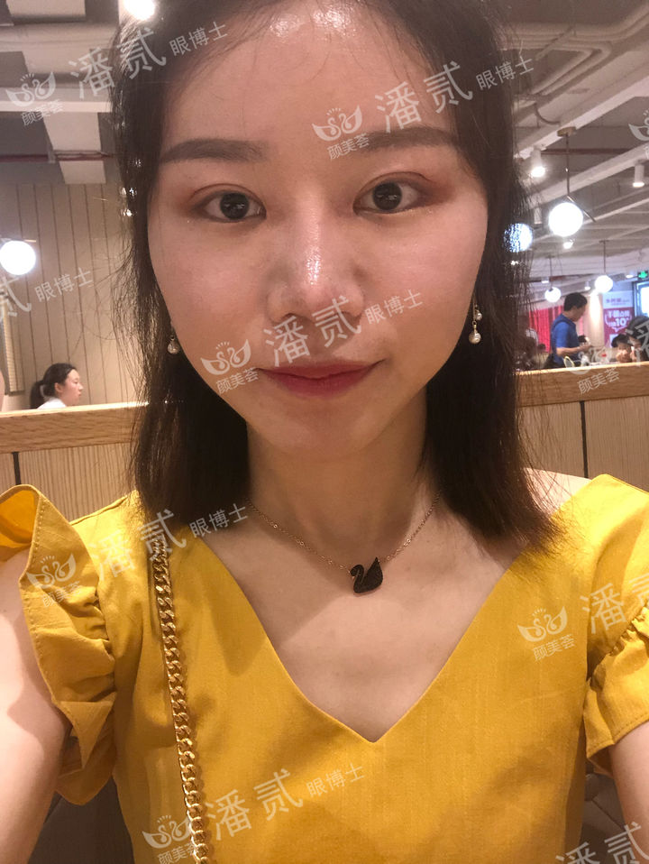 开眼角过大图片,开眼角过大修复效果图