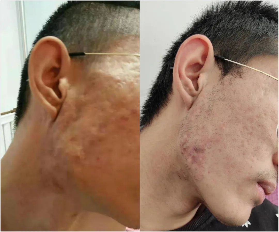 长痘留下难看的痘印痘坑,脸上起痘后留下疤痕如何消除