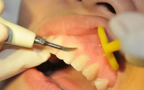 牙医眼中的洗牙竟然这么神奇,可以“包治口腔百病”