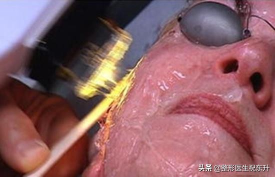 做光子嫩肤前后应注意事项,关于做光子嫩肤的分享