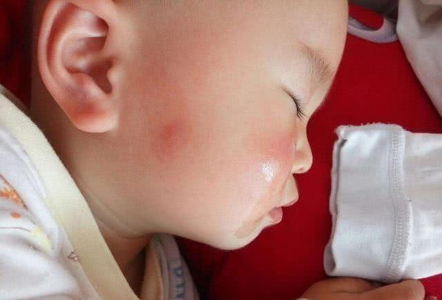 孩子被咬后，若呈现这些状况代表不是蚊子咬的包，别自行处理