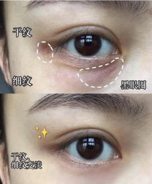 正确涂眼霜淡化黑眼圈的方法,你还在用眼霜淡化鱼尾纹吗