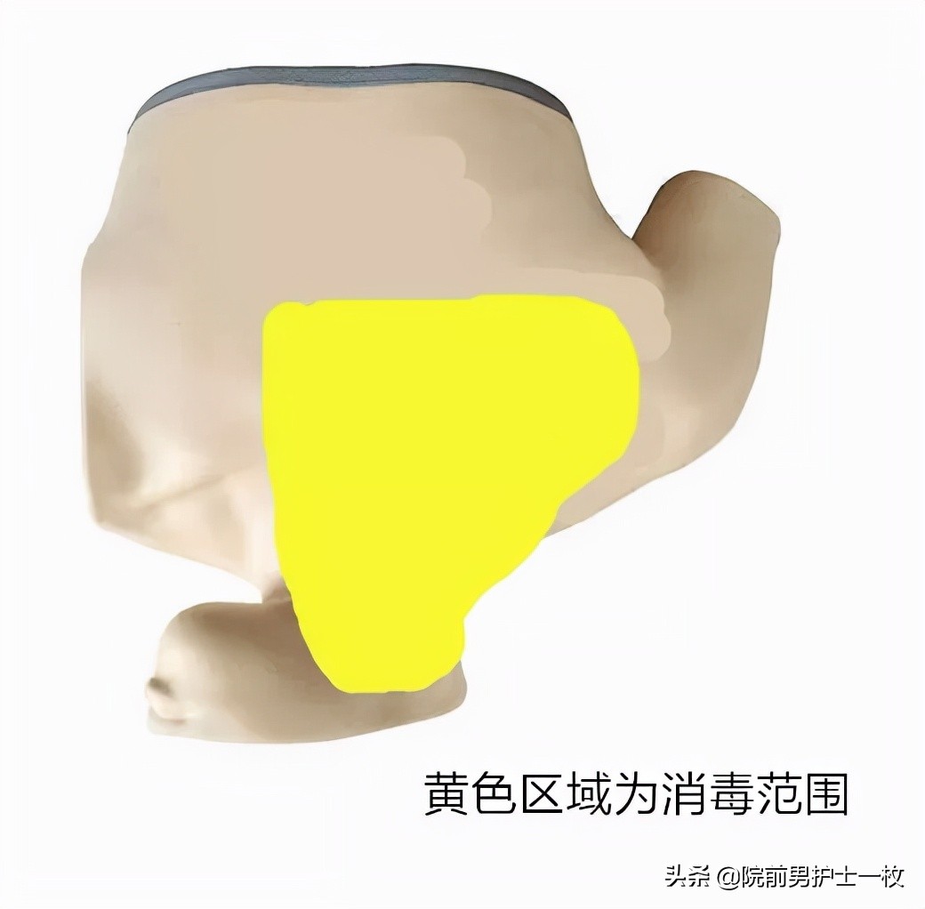 深静脉置管锁骨下静脉穿刺部位,深静脉穿刺置管拔出需要注意什么