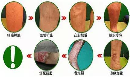 腿上有蚯蚓纹怎么回事,腿上出现蚯蚓似的纹路是怎么回事