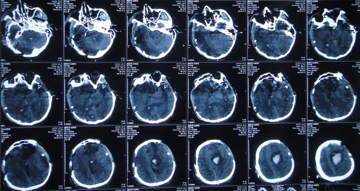 脑受伤开颅手术昏迷,开颅手术后20天发生脑积水引流