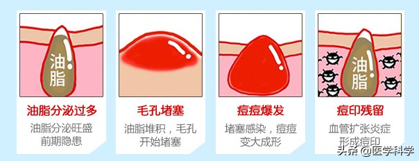 下巴爱长脓包痘痘是什么原因,下巴爱长白头粉刺