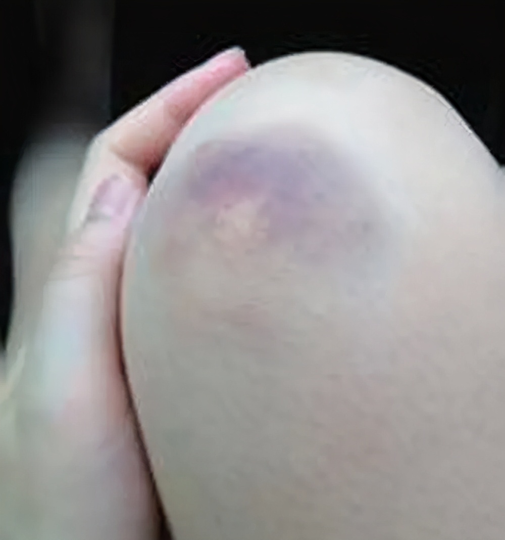 被马蜂叮咬后怎样处理,小磕小碰刮擦自己处理