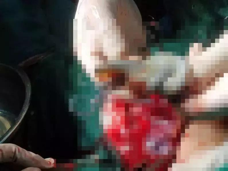 35岁的女子怀孕31周竟是三胞胎,女子怀孕40周胎死腹中