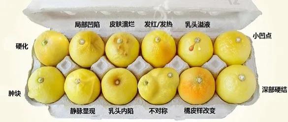 做好情绪管理战胜乳腺增生,做好情绪管理有什么作用