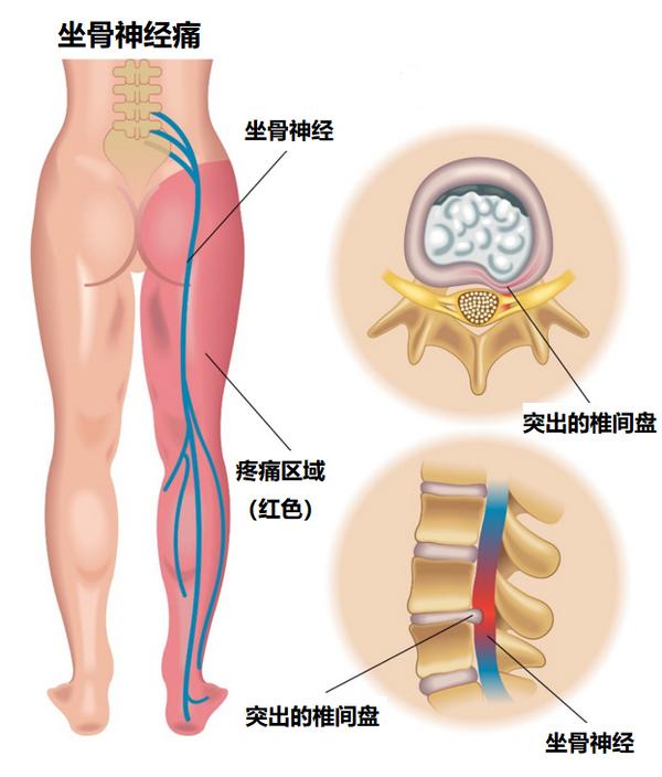 得了腰椎间盘突出症是不是人就废了,得了腰椎间盘突出症状怎么消失