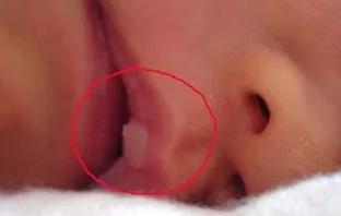 马牙宝宝有什么表现,马牙婴儿怎么治疗