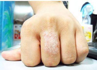 儿童牛皮癣怎么治疗才能彻底根除,目前全国治疗牛皮癣用的生物制剂