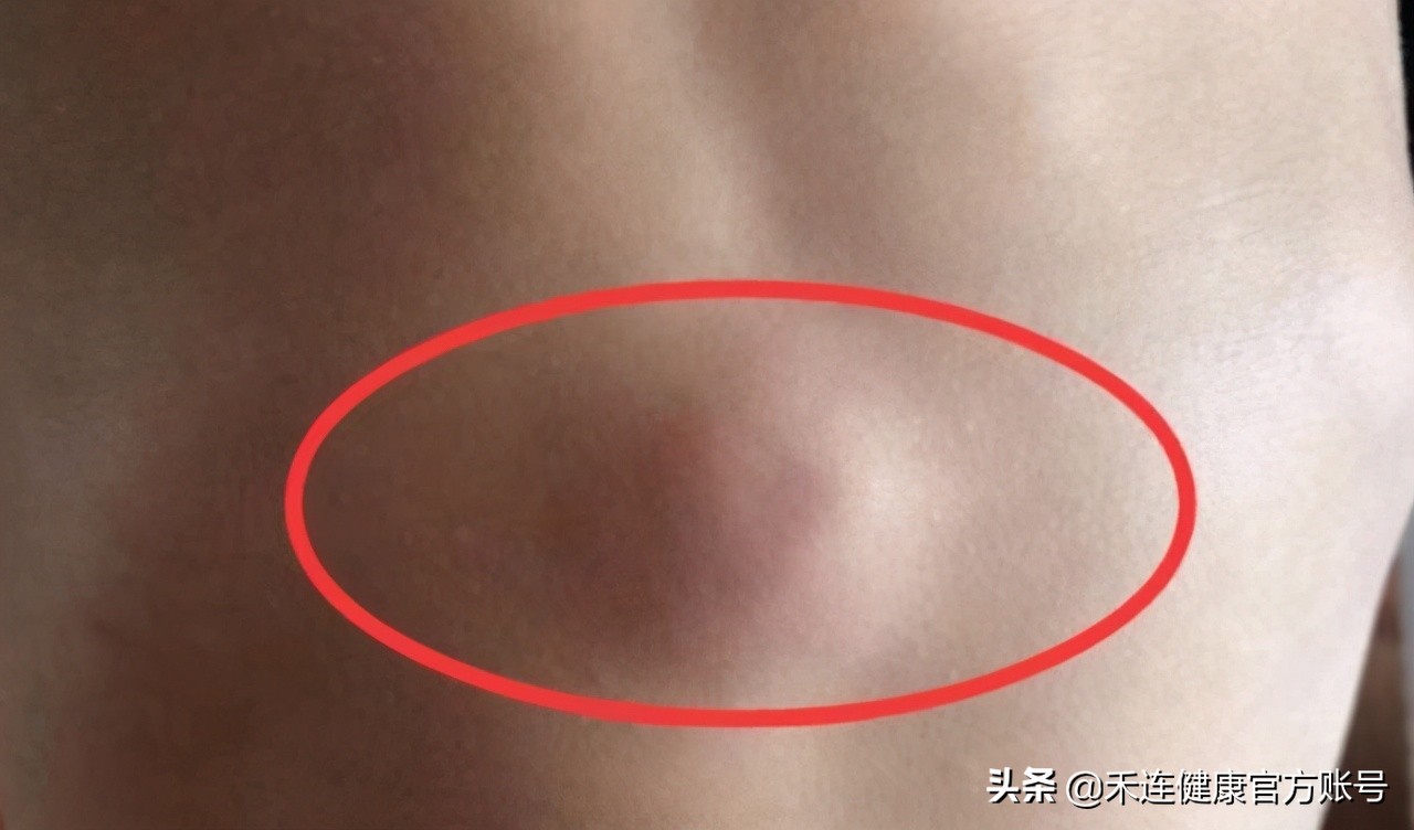 癌症肚子又胀又大是什么癌,什么癌症晚期症状是肚子变大