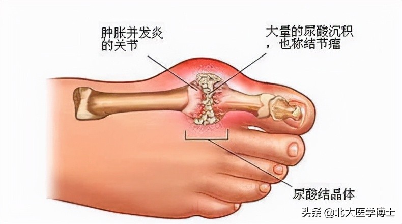 痛风结石排石药,老中医尿结石中药排石配方