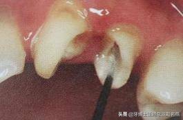 纤维桩修复费用,纤维桩修复全过程视频