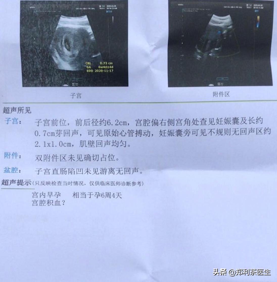 宫角妊娠导致胎停是异位妊娠吗,宫角妊娠是异位妊娠么