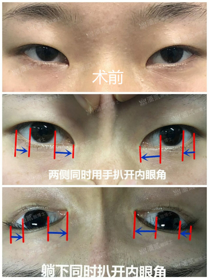 开眼角为什么分内眼角和外眼角,开眼角之后反而变丑了