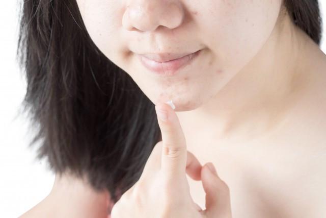 怎么祛痘印最快最有效的方法,怎么祛痘印的最有效方法