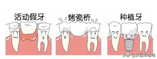 缺失两颗牙修复最佳方式,游离端缺失两颗牙做活动义齿