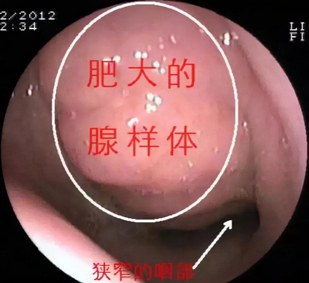孩子打鼾别大意警惕腺样体肥大,孩子打鼾一定是腺样体肥大么